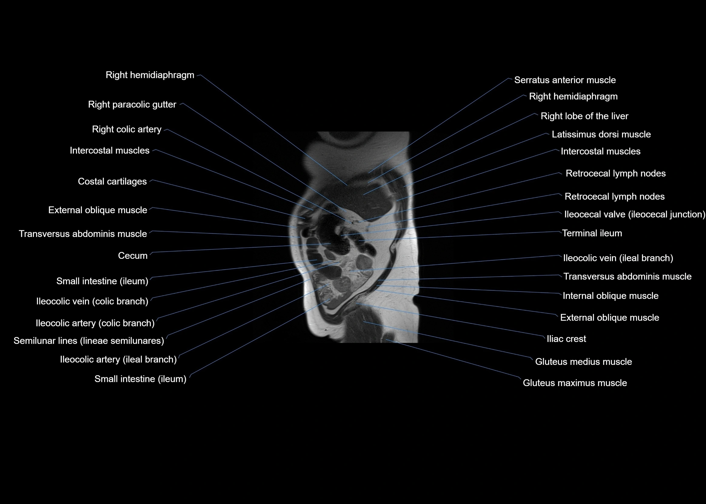 MRI abdomen sagittal cross sectional anatomy  radiology  image-img-00001-00011.webp
